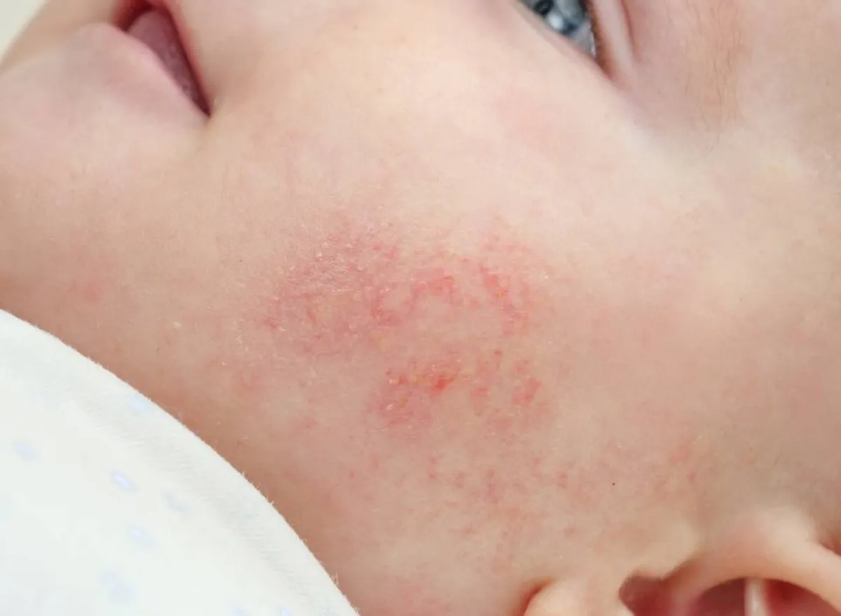 صورة لوجه طفل مصاب بالأكزيما