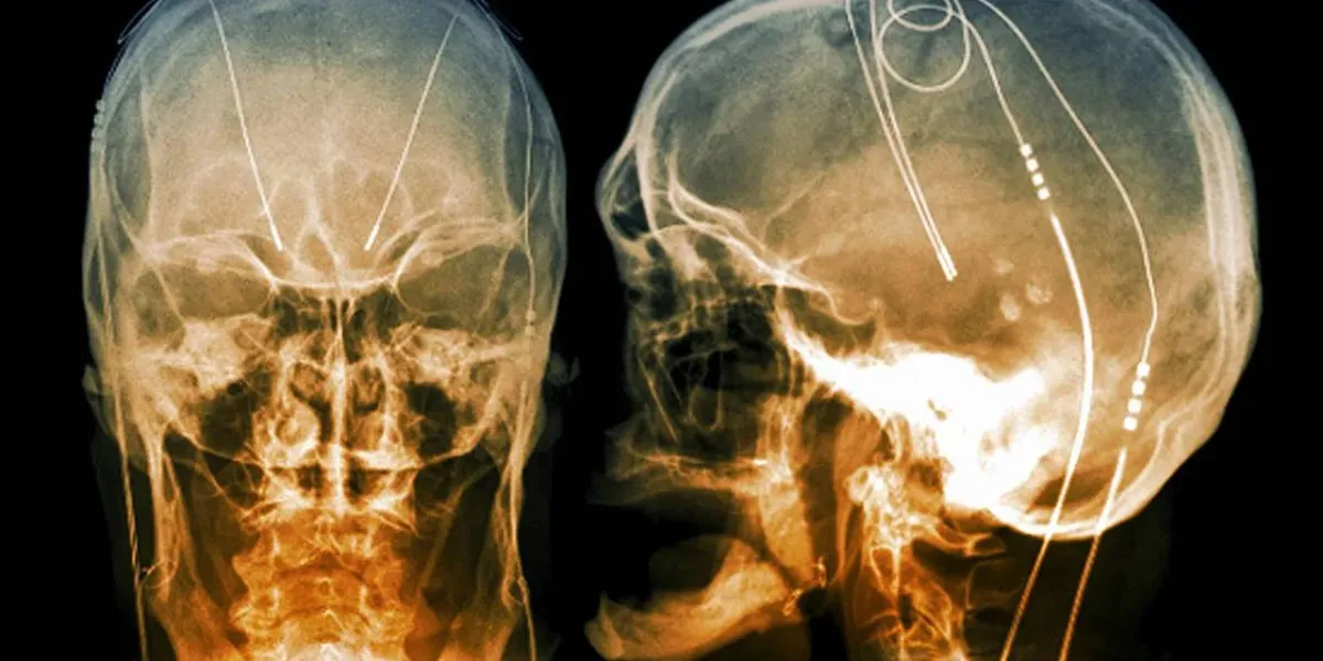 «شريحة دماغ» تتعامل مع أعراض مرض باركنسون