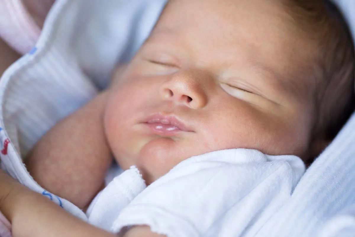 صورة لرضيع يعاني من اللسان المربوط