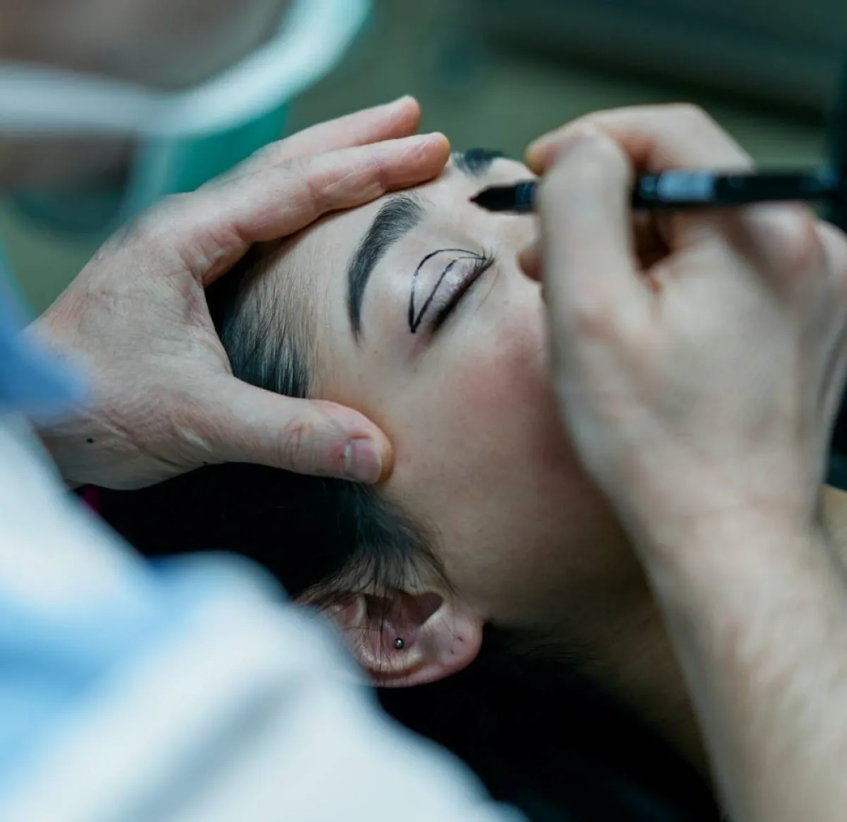 صورة لعملية تجميل في الجفنين