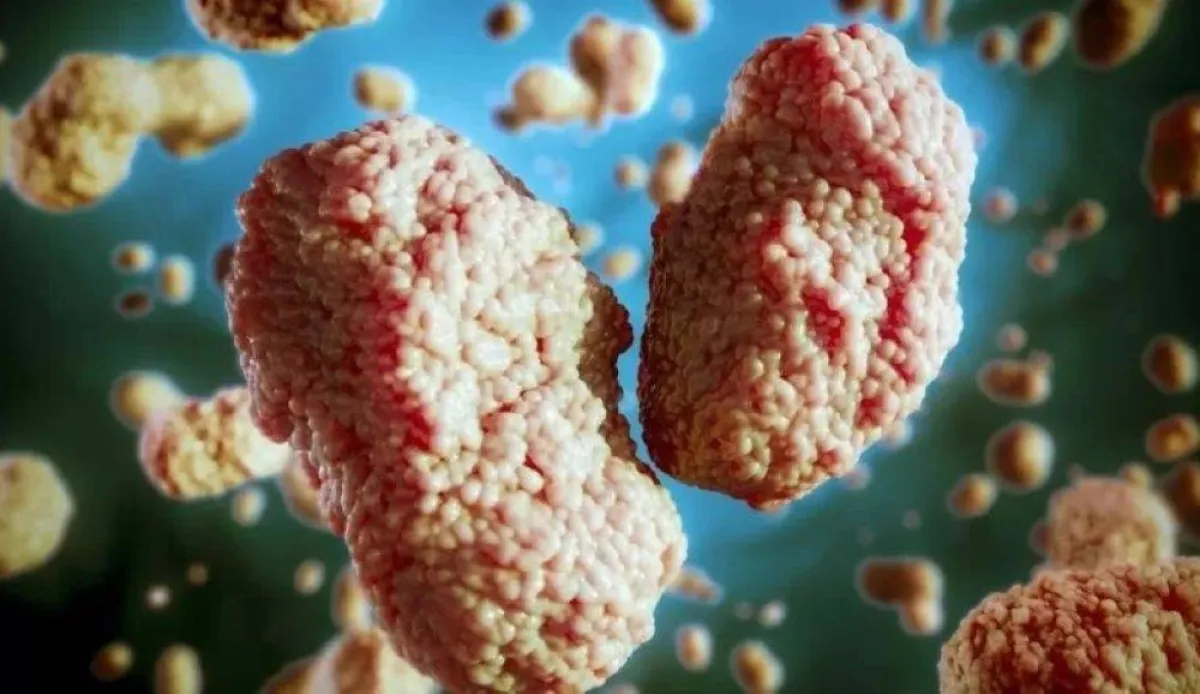 جدري القردة