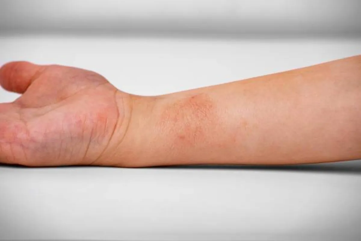 صورة لطفح جلدي بسبب الحساسية الغذائية