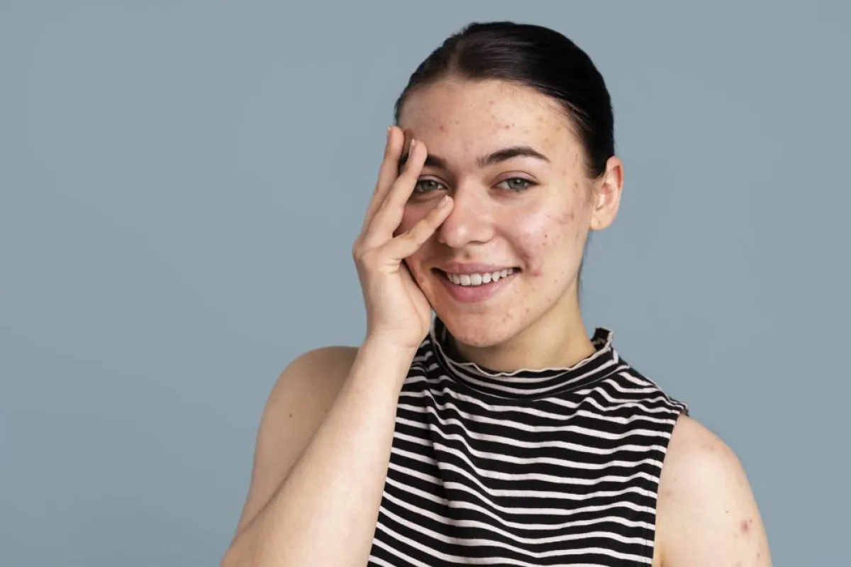 التقرن الشعري هو حالة جلدية شائعة تسبب بقع صغيرة حمراء أو بيضاء على الجلد