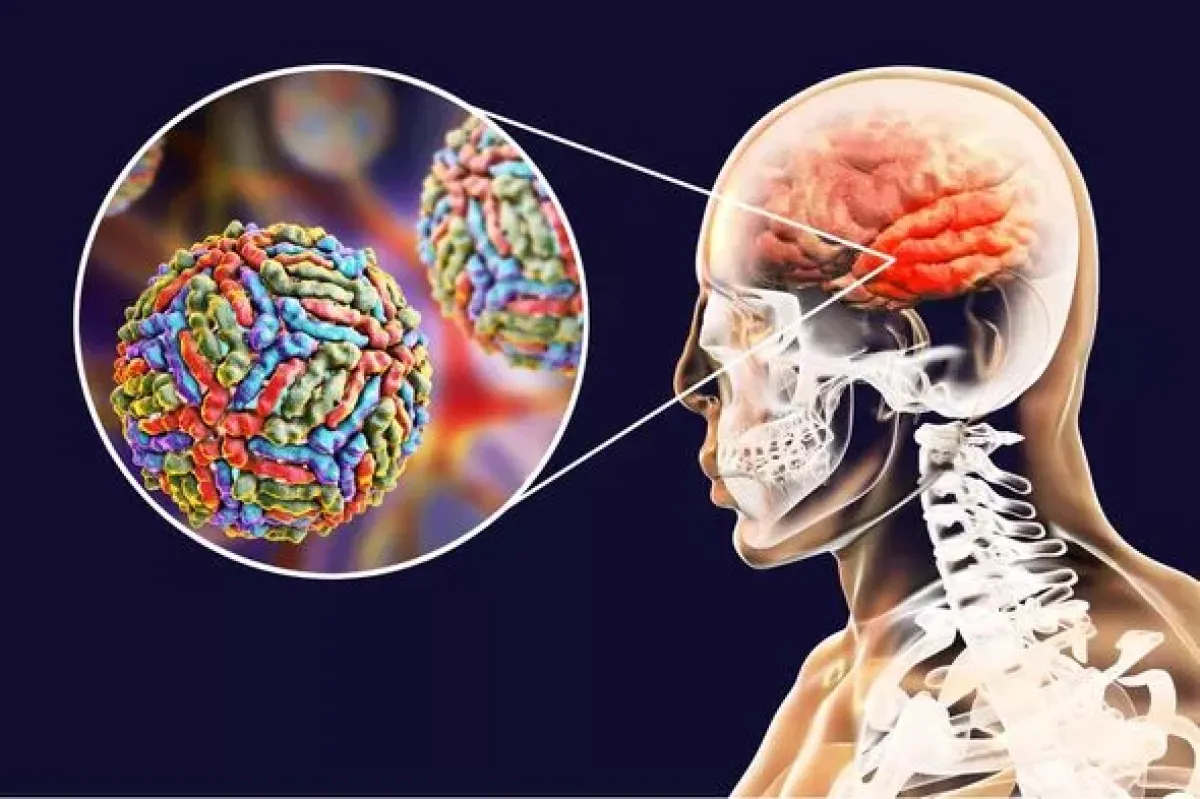 صورة توضيحية لإصابة بورنا دماغ الإنسان - الصورة من ديلي إكسبرس