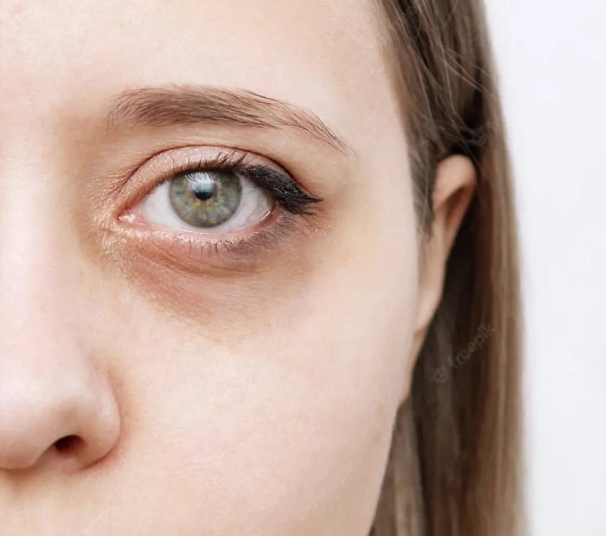 هالات العين