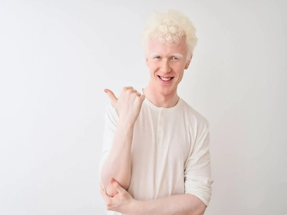 من أعراض البهاق البشرة والشعر والعيون الشاحبة