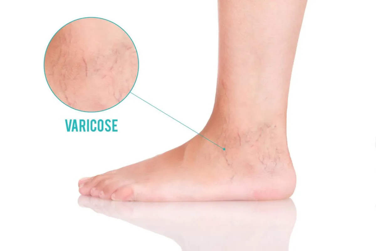 صورة لدوالي الرجلين