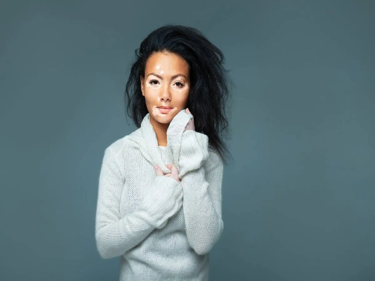 أبرز المعلومات عن مرض البهاق، في اليوم العالمي للبهاق