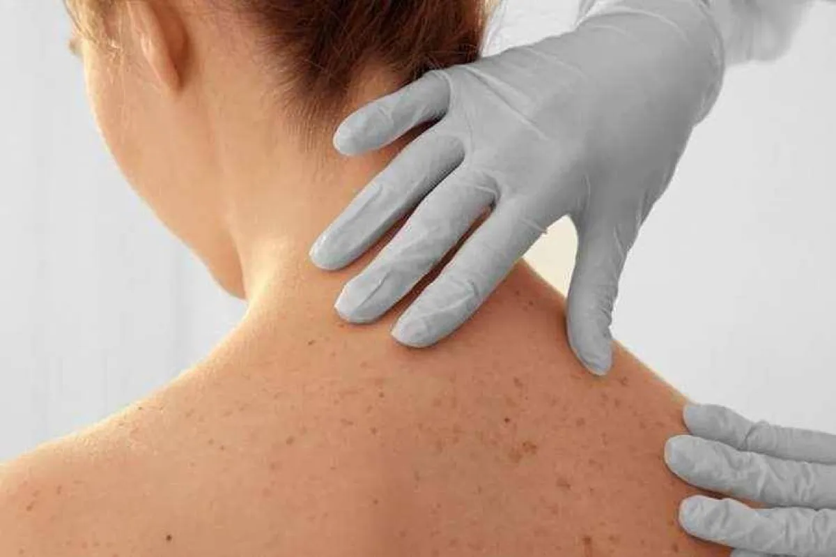 سرطان الجلد: غالباً ما يتم إغفال تطبيق الحماية على هذه المنطقة