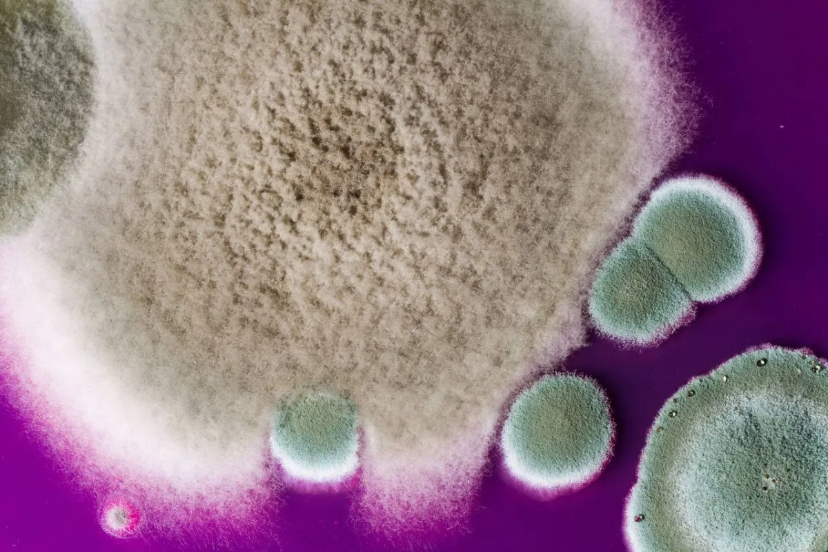 صورة للعدوى الفطرية