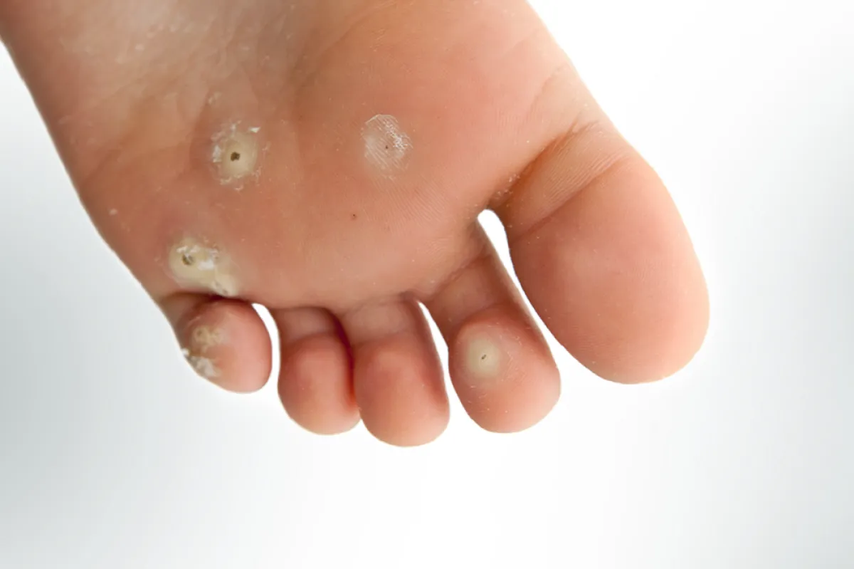 مسامير القدم