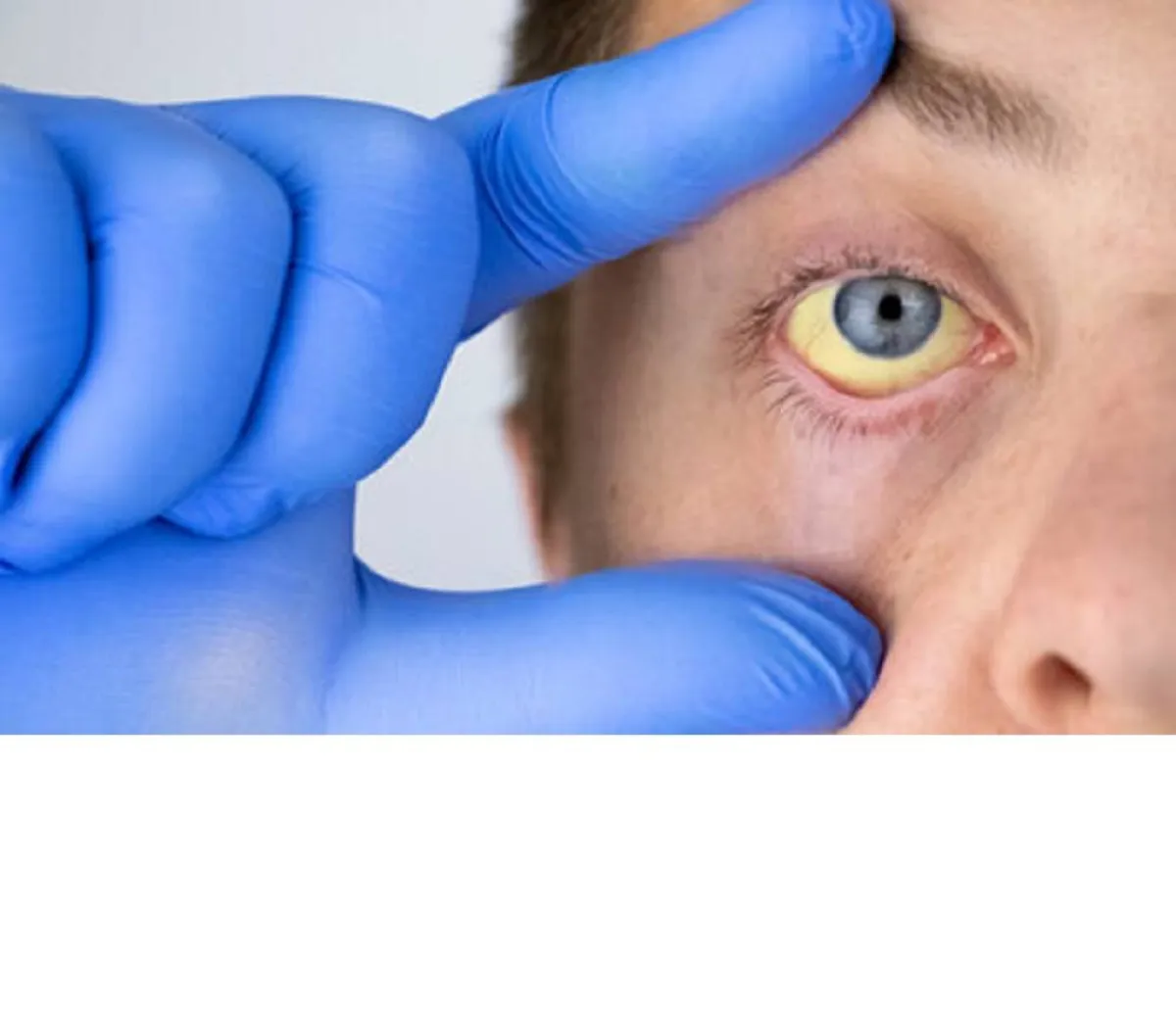  اصفرار الجلد وبياض العين أحد أعراض الإصابة بالتهاب الكبد