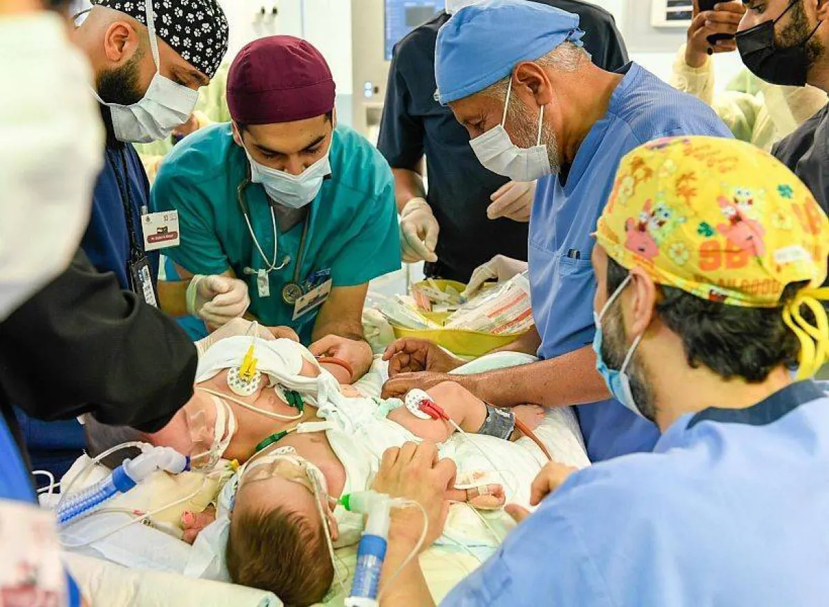 نجاح عملية فصل التوأم اليمني "مودة ورحمة" دون مضاعفات