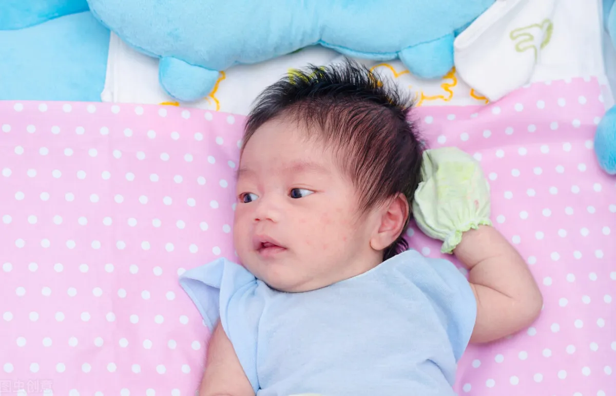 حب الشباب عند الأطفال