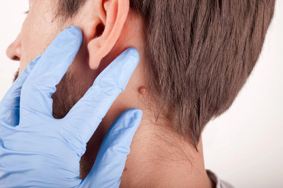  لا يجب تشخيص الزوائد الجلدية في المنزل ومن الآمن دائمًا أن يتم تشخيصها من قبل الطبيب