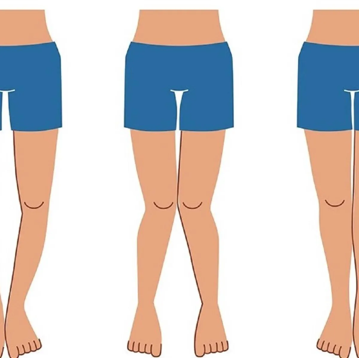 صورة تعبيرية لتقوس الساقين