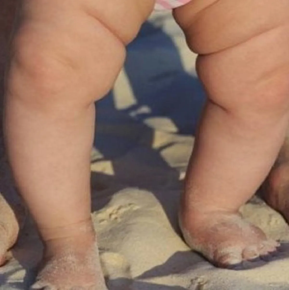 صورة لطفل متقوس الساقين