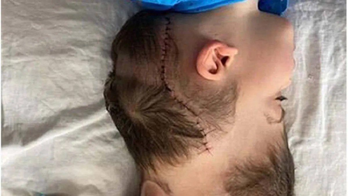 صورة للتوأم الملتصق