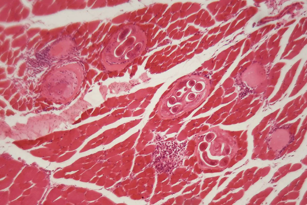 أمراض الأمعاء الالتهابية 