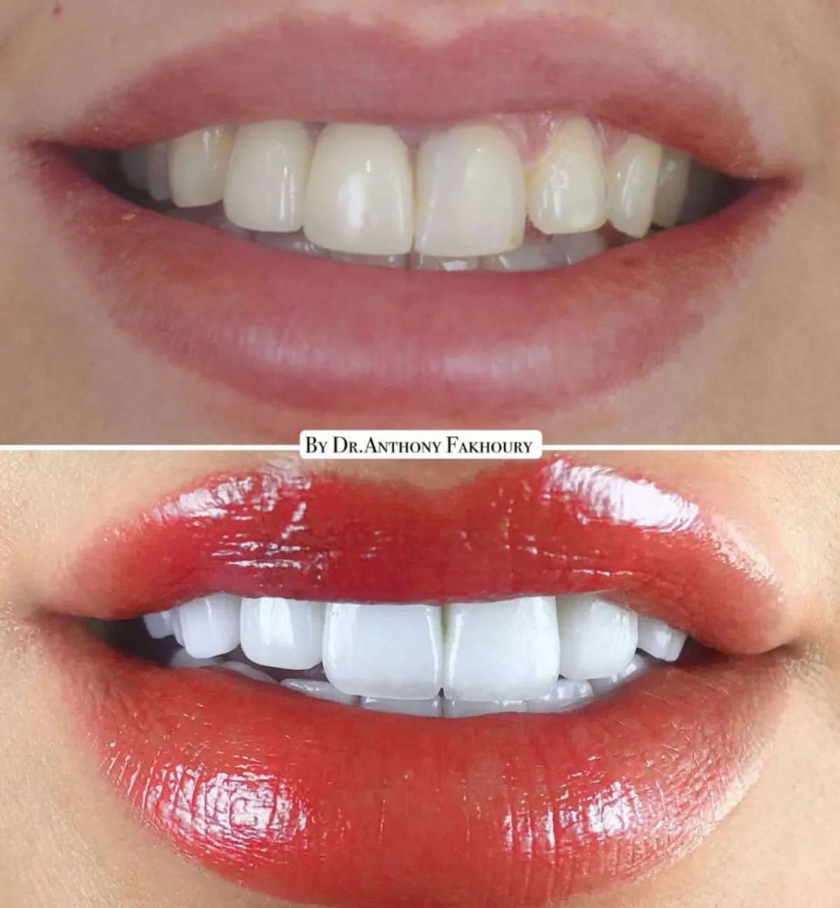 ترتيب وتجميل الأسنان قبل وبعد