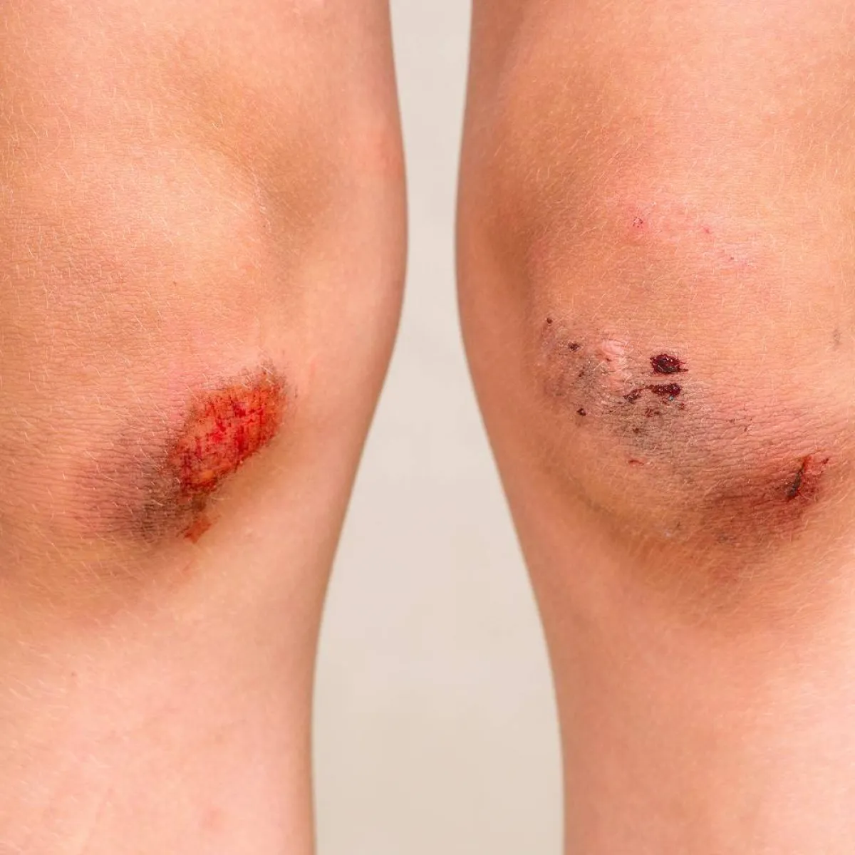 صورة لكدمات بالأرجل