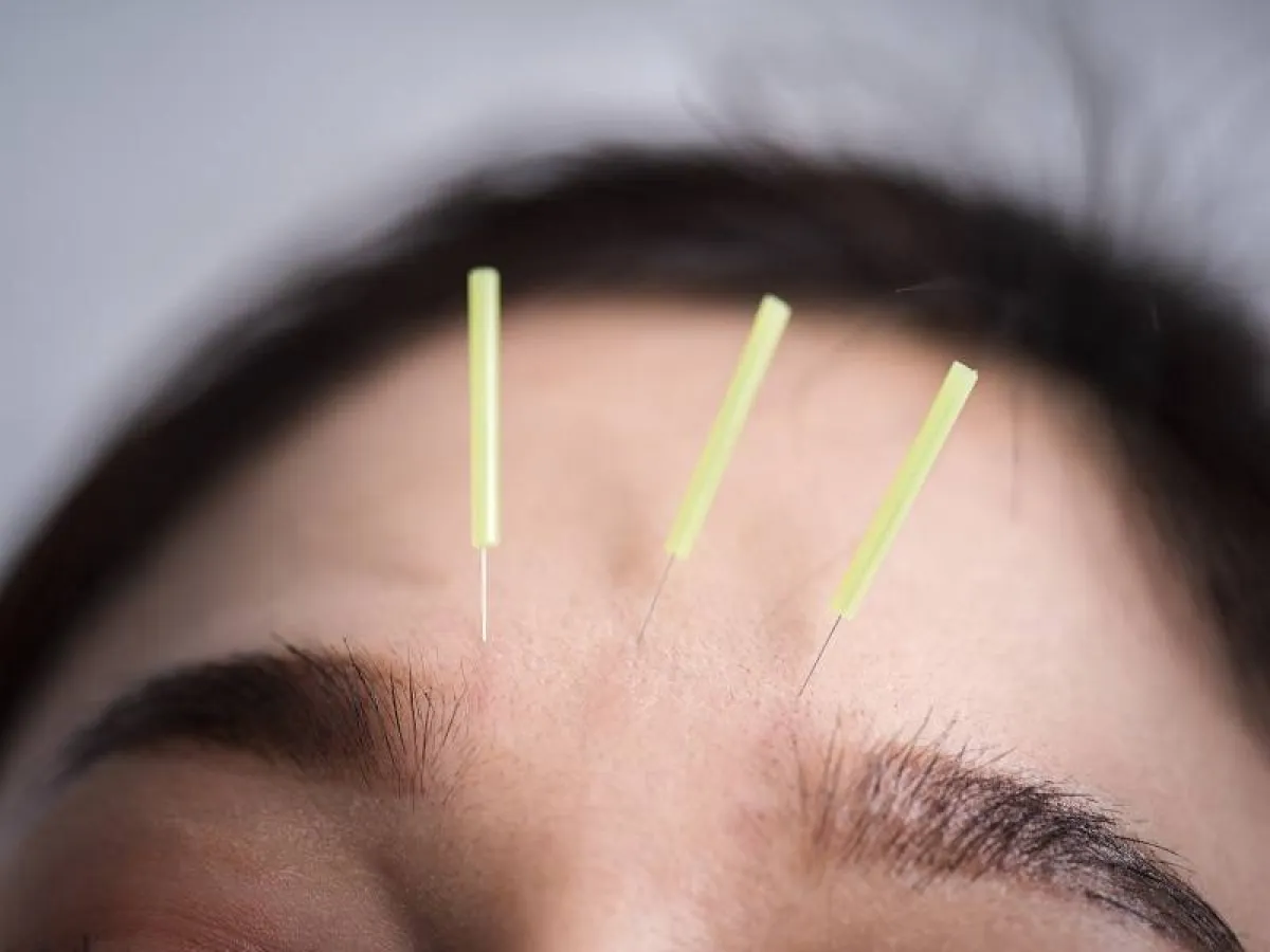 العلاج بالإبر الصينية فعّال ضد السمنة ويساعد في تنظيم بعض الهرمونات والمواد الكيميائية