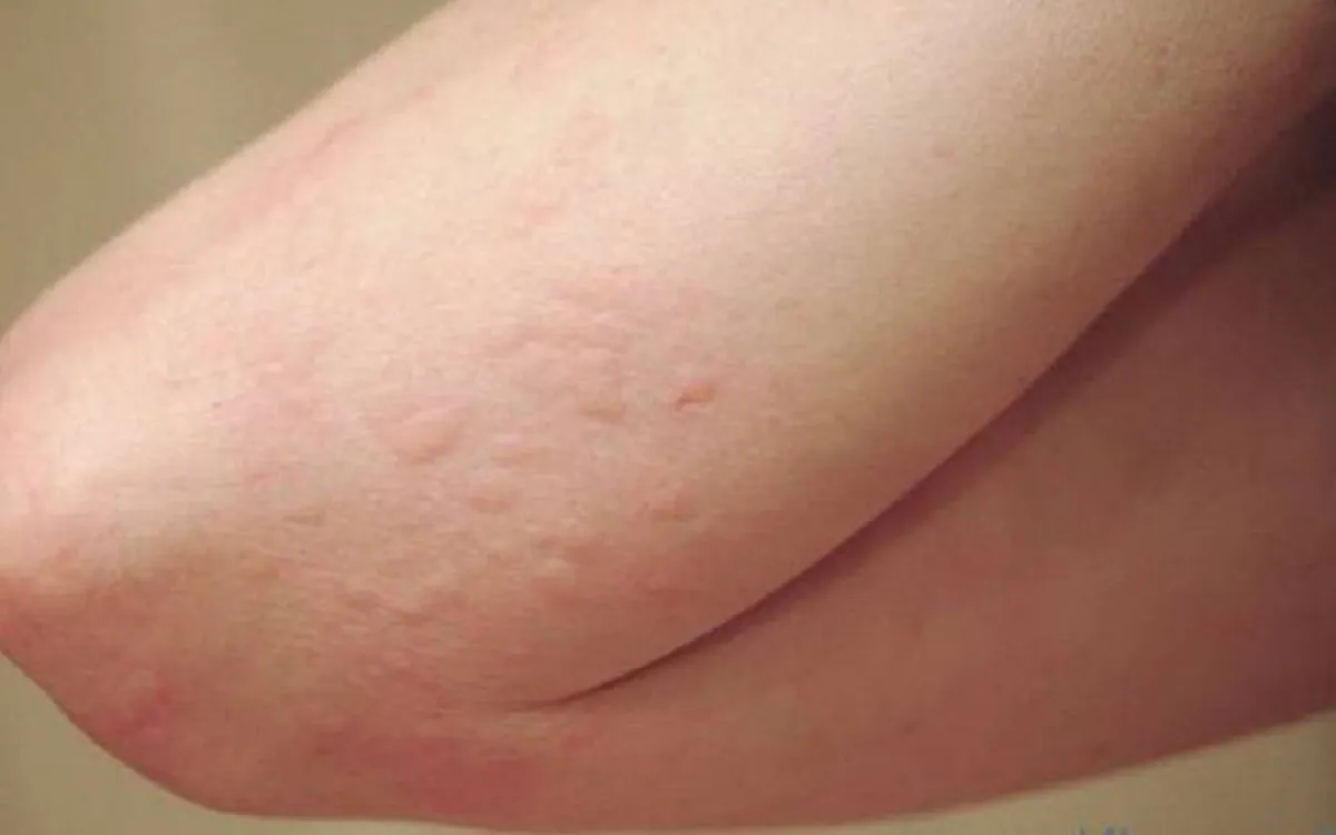 الطفح الجلدي من أعراض حساسية القمح