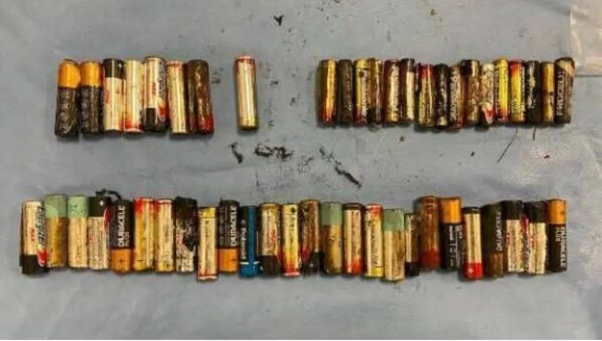 سيدة تبتلع 55 بطارية