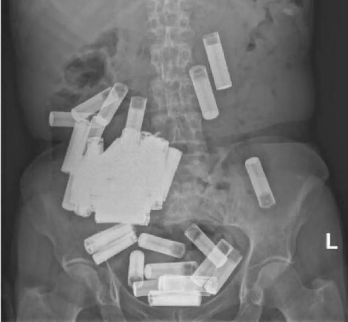سيدة تبتلع 55 بطارية