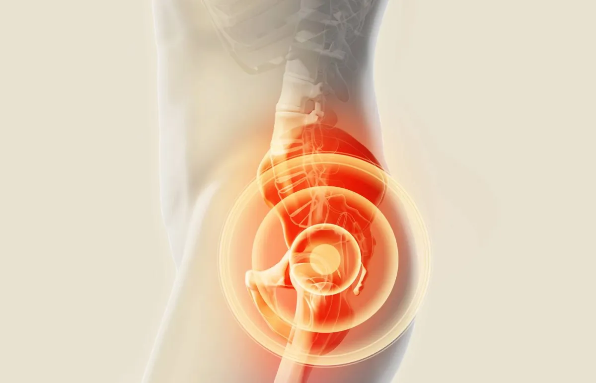 متلازمة اصطكاك الورك المفصلية «الورك الراقص» .. وأفضل طرق العلاج