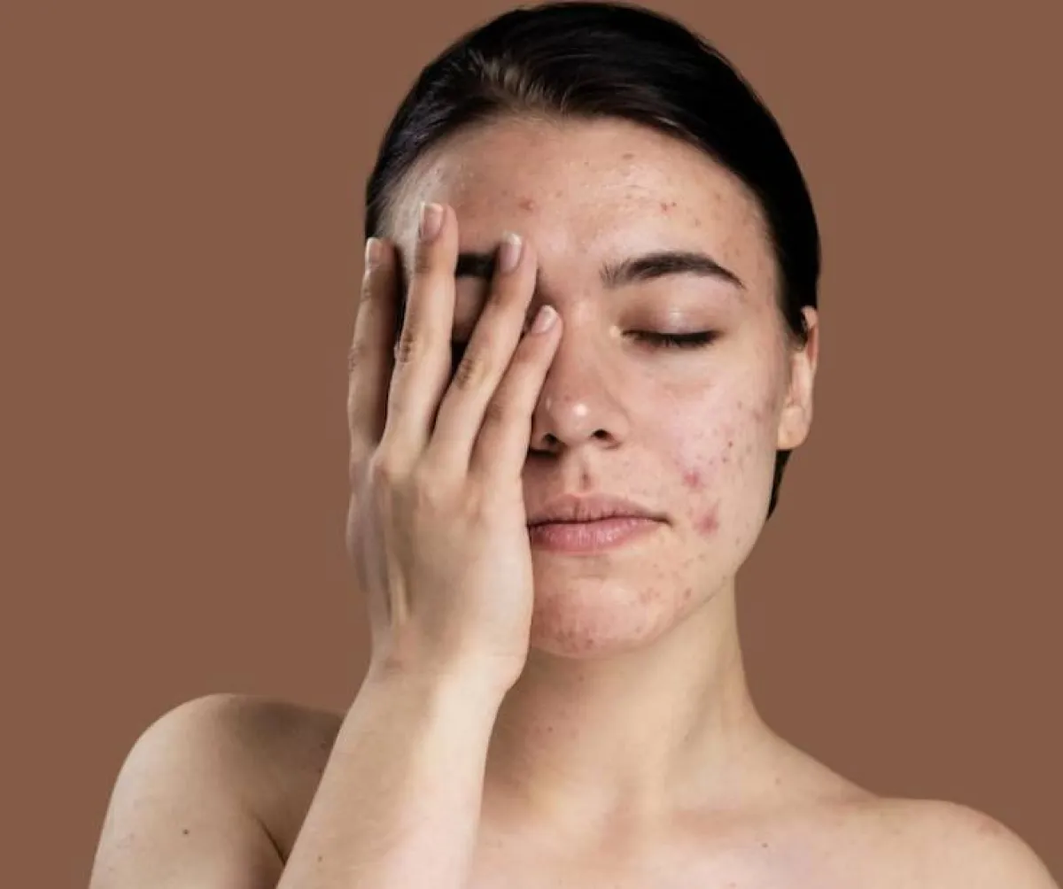 كيفية علاج حب الشباب بالثوم في يوم واحد