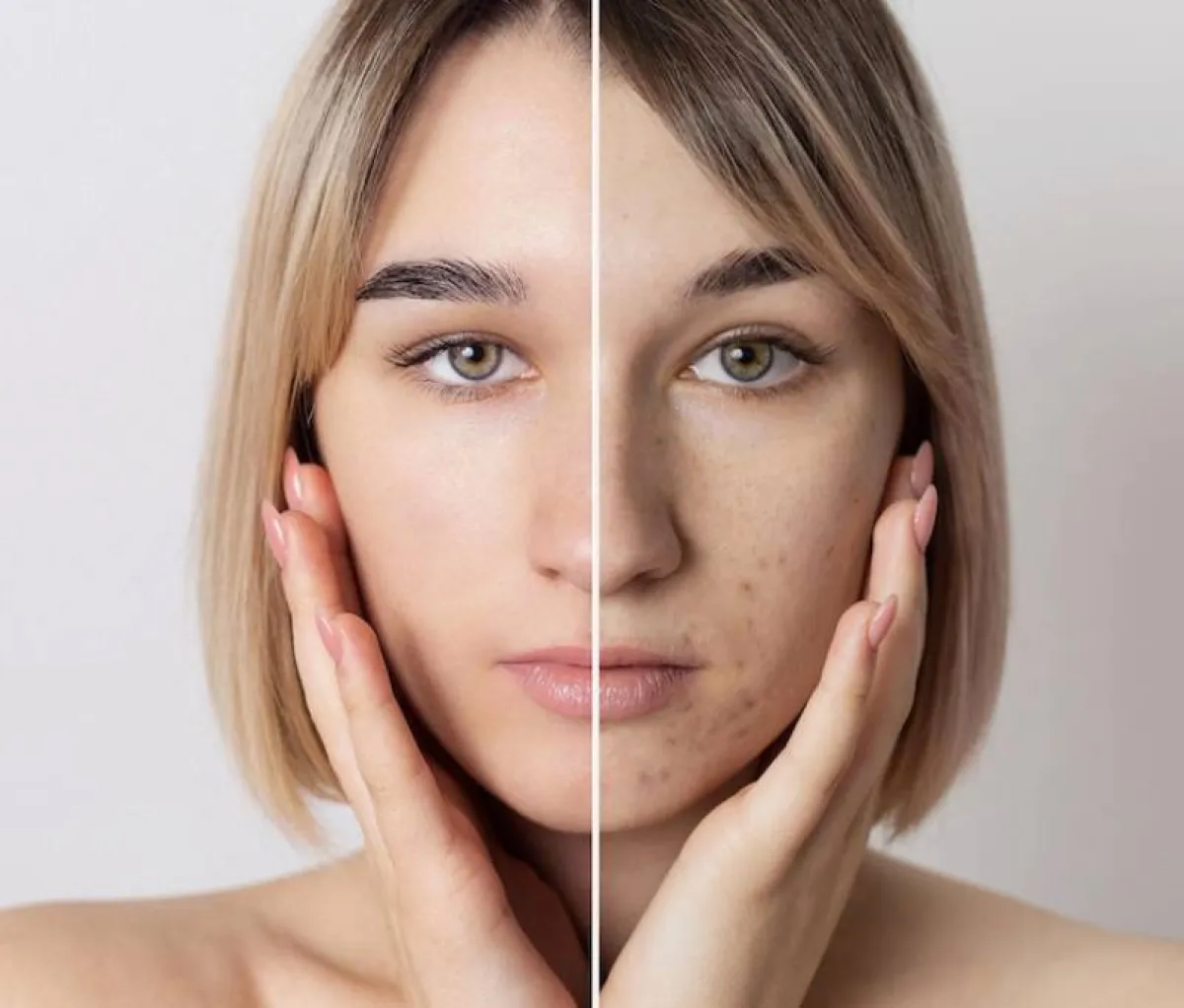 لماذا يكون الثوم مفيداً في علاج حب الشباب؟