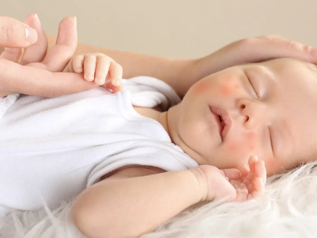 صورة لطفل مريض بمرض جلدي