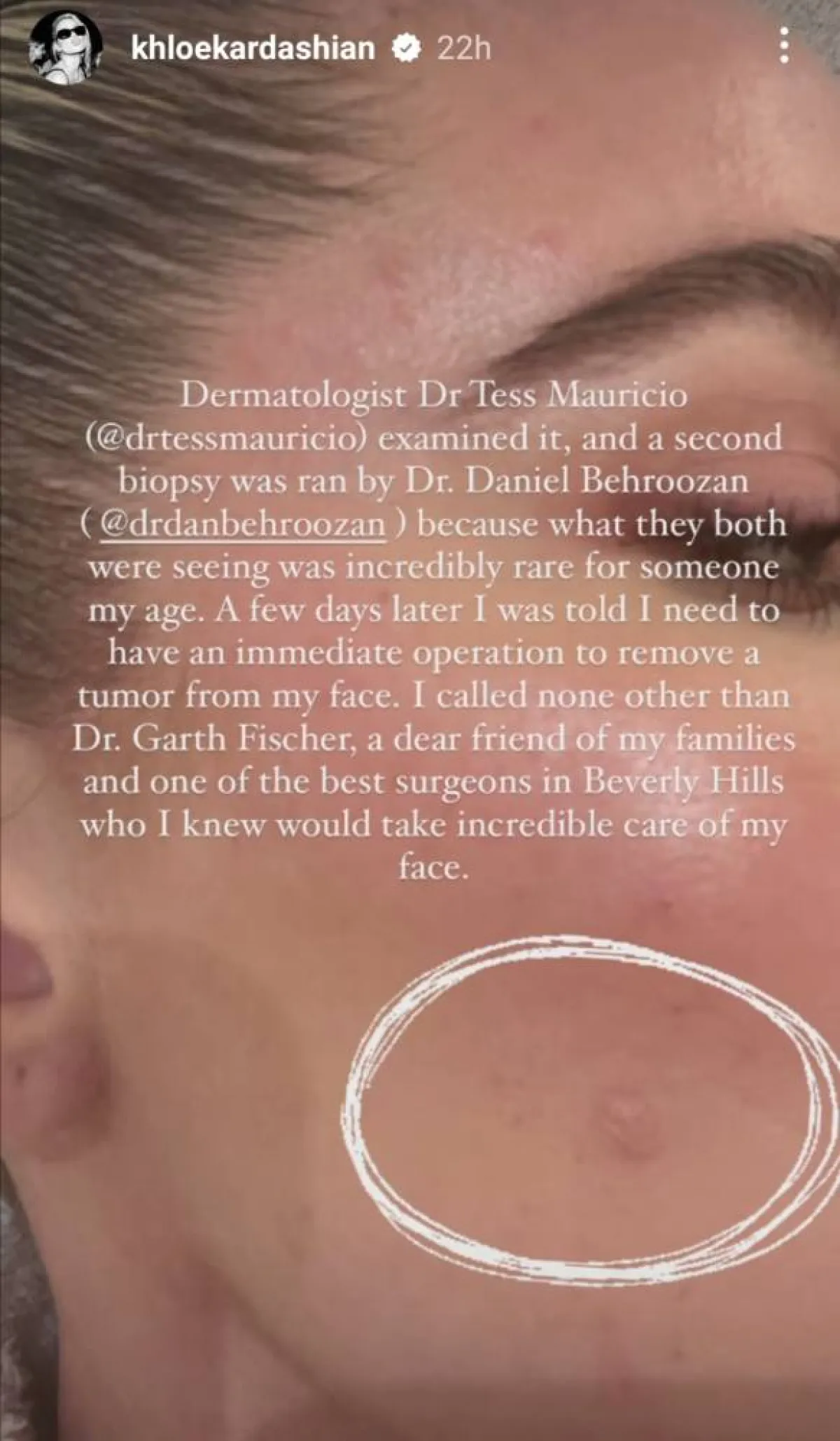 كلوي كارداشيان توضح إصابتها بورم نادر- الصورة من قصص إنستغرام الخاصة بها