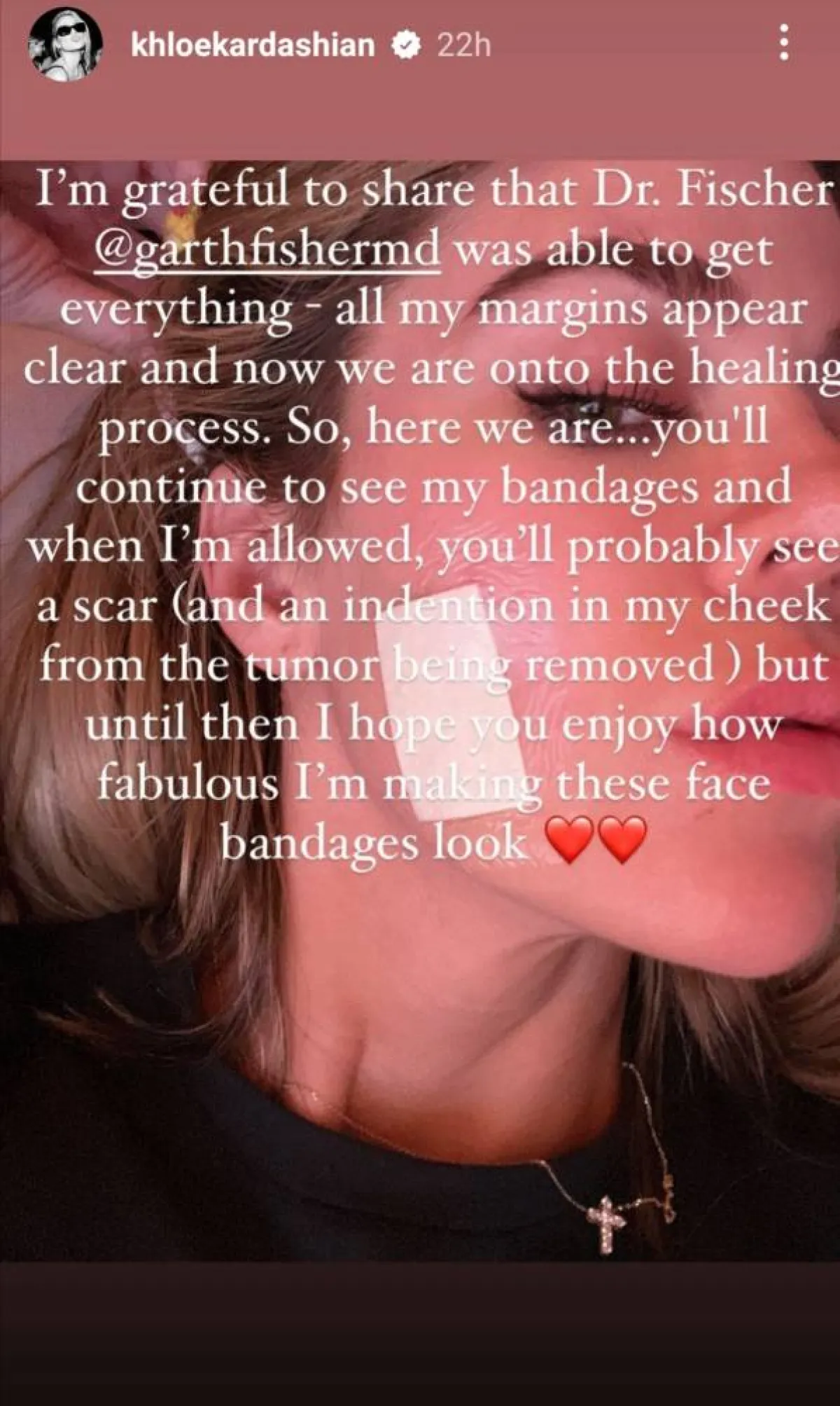 كلوي كارداشيان تكشف عن إصابتها بسرطان الجلد- الصورة من قصص إنستغرام الخاصة بها