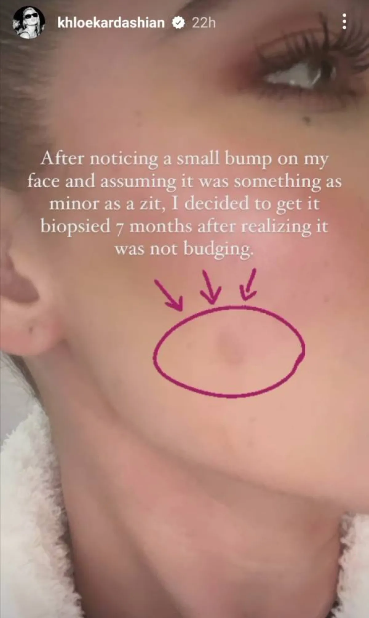 كلوي كارداشيان تكشف عن إصابتها بورم نادر في الوجه- الصورة من قصص إنستغرام الخاصة بها