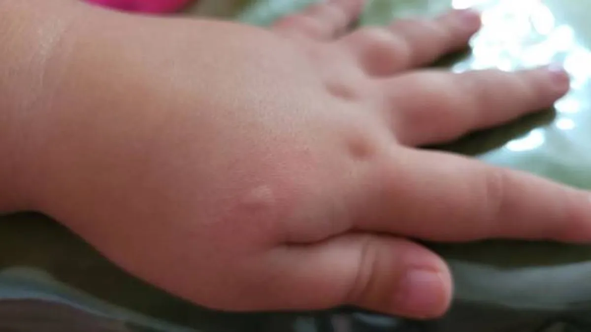 صورة طفل يعاني من حساسية جلدية