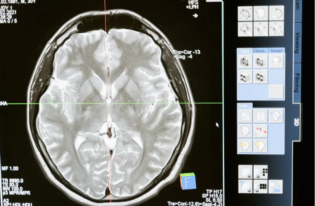 طفرة في مجال الطب النفسي.. جامعيات يطلقن مشروعا ينظم المشاعر عبر "كهربائية الدماغ"