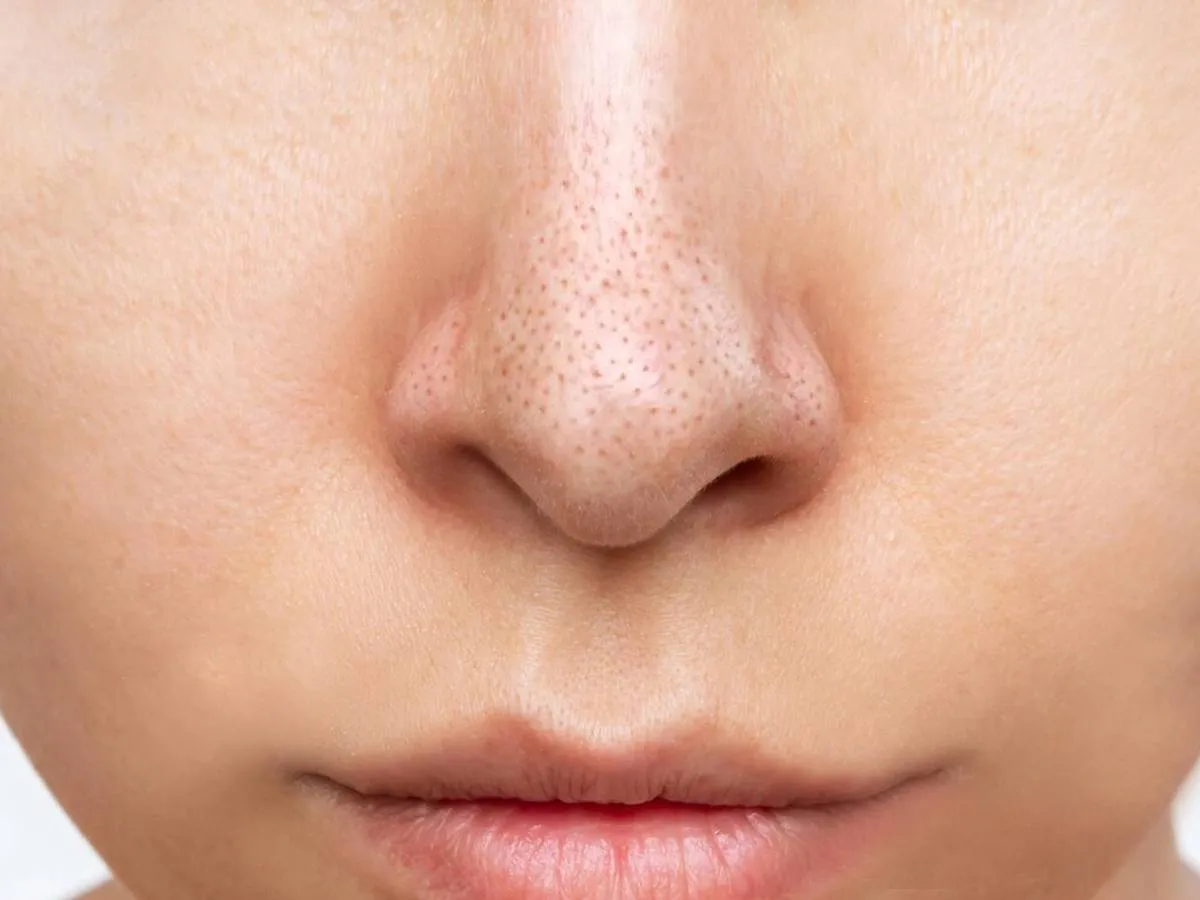 إزالة الرؤوس السوداء من الوجه في 10 دقائق فقط