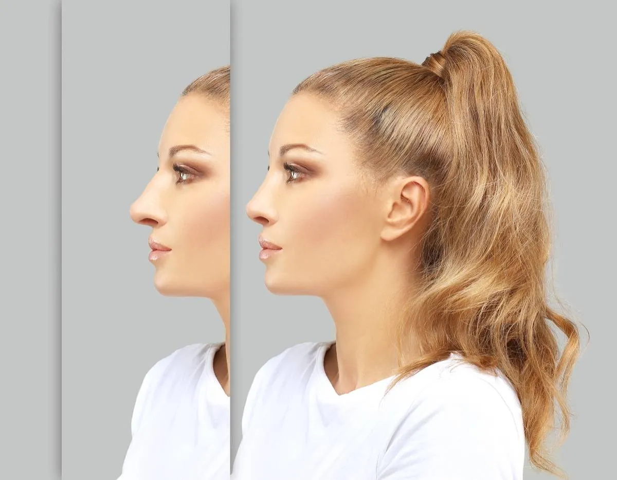 تجميل الأنف