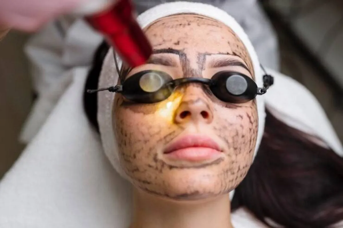 التقشير بالليزر الكربوني