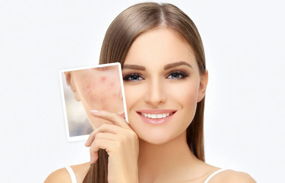 حب الشباب أنواعه وطرق علاجه Acne Treatments
