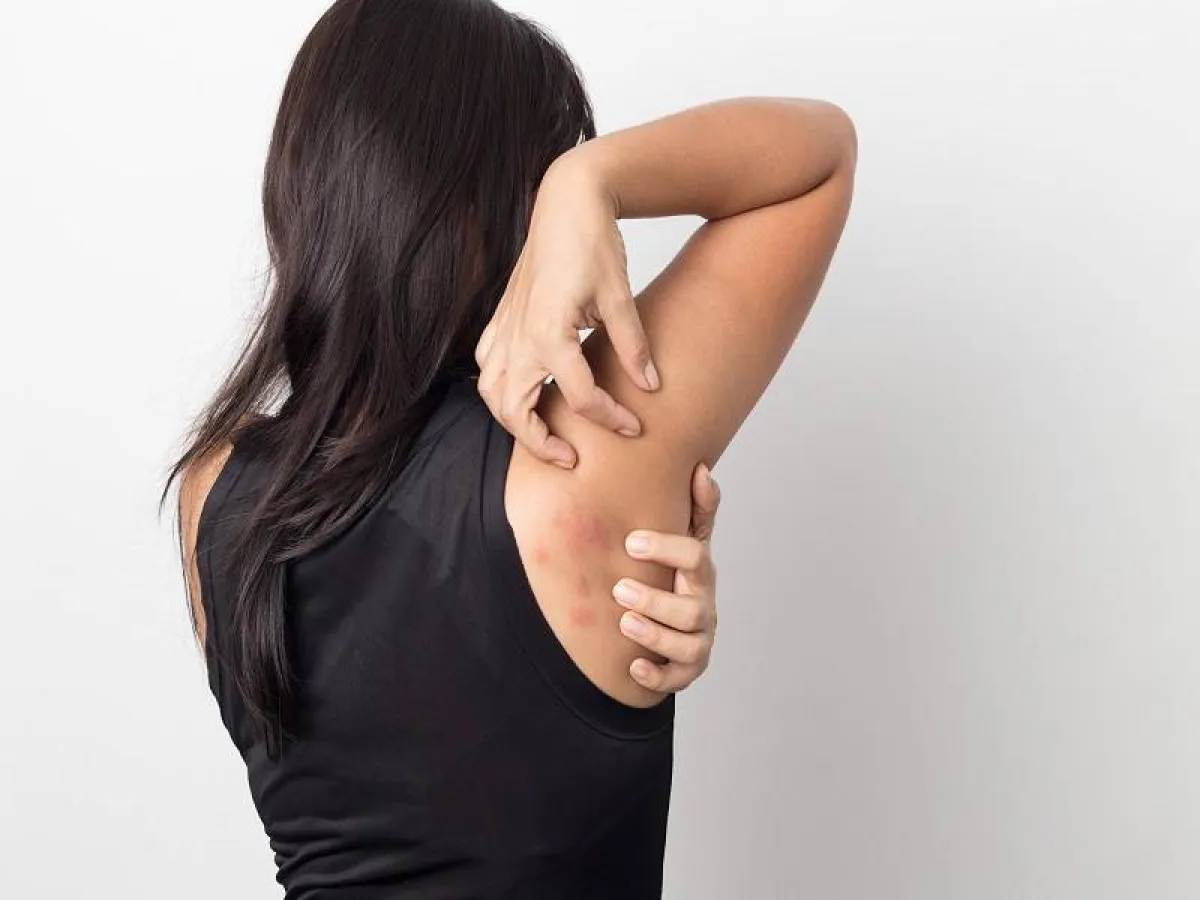 ينتج الطفح الجلدي عن ضعف الدورة الدموية أو مسببات الحساسية أو العدوى «المصدر: Adope.stock»