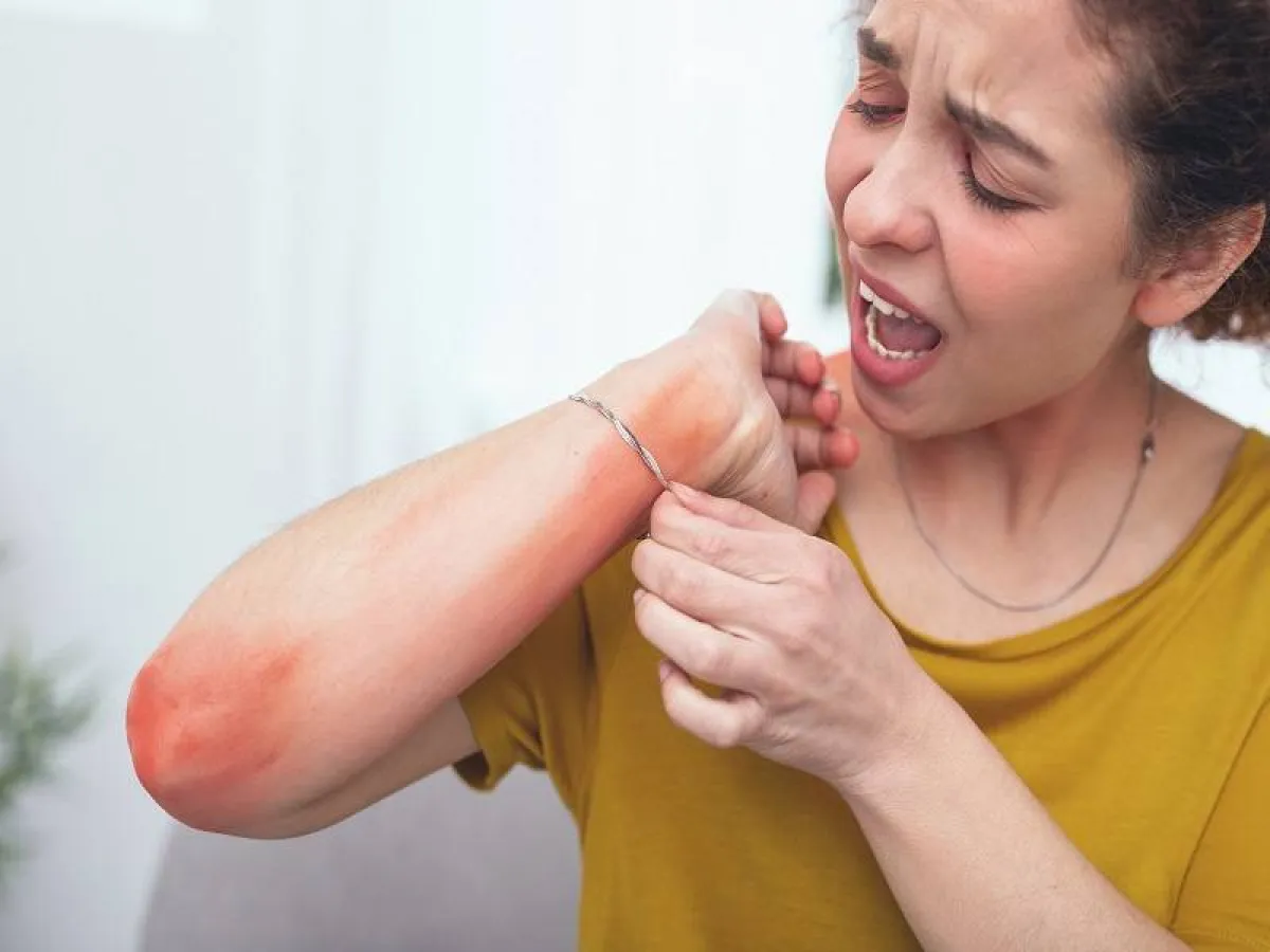 من أعراض حمى الضنك طفح جلدي أحمر منتشر (المصدر :Adope.stock)