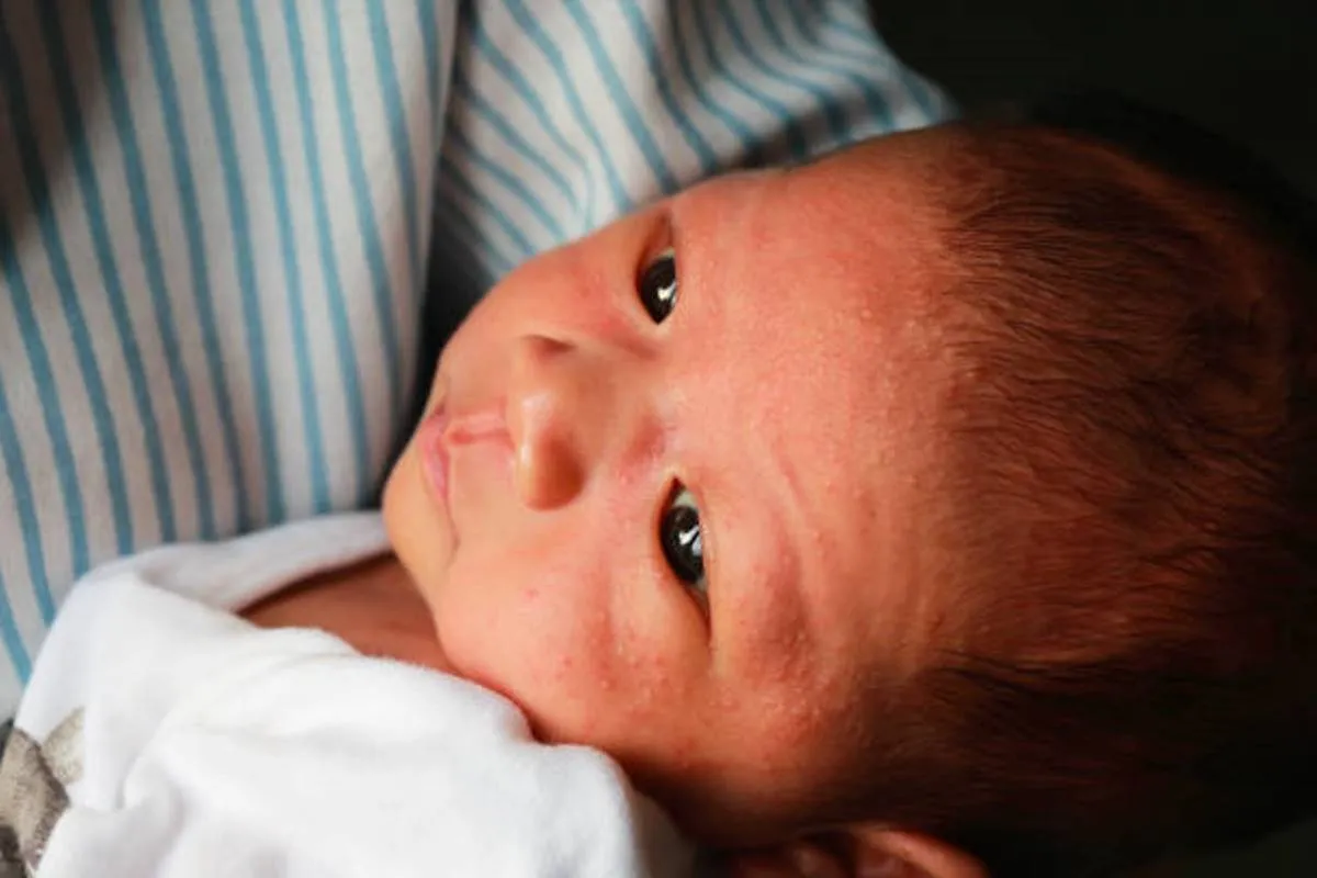 صورة لحبوب حمراء ظهرت على وجه المولود