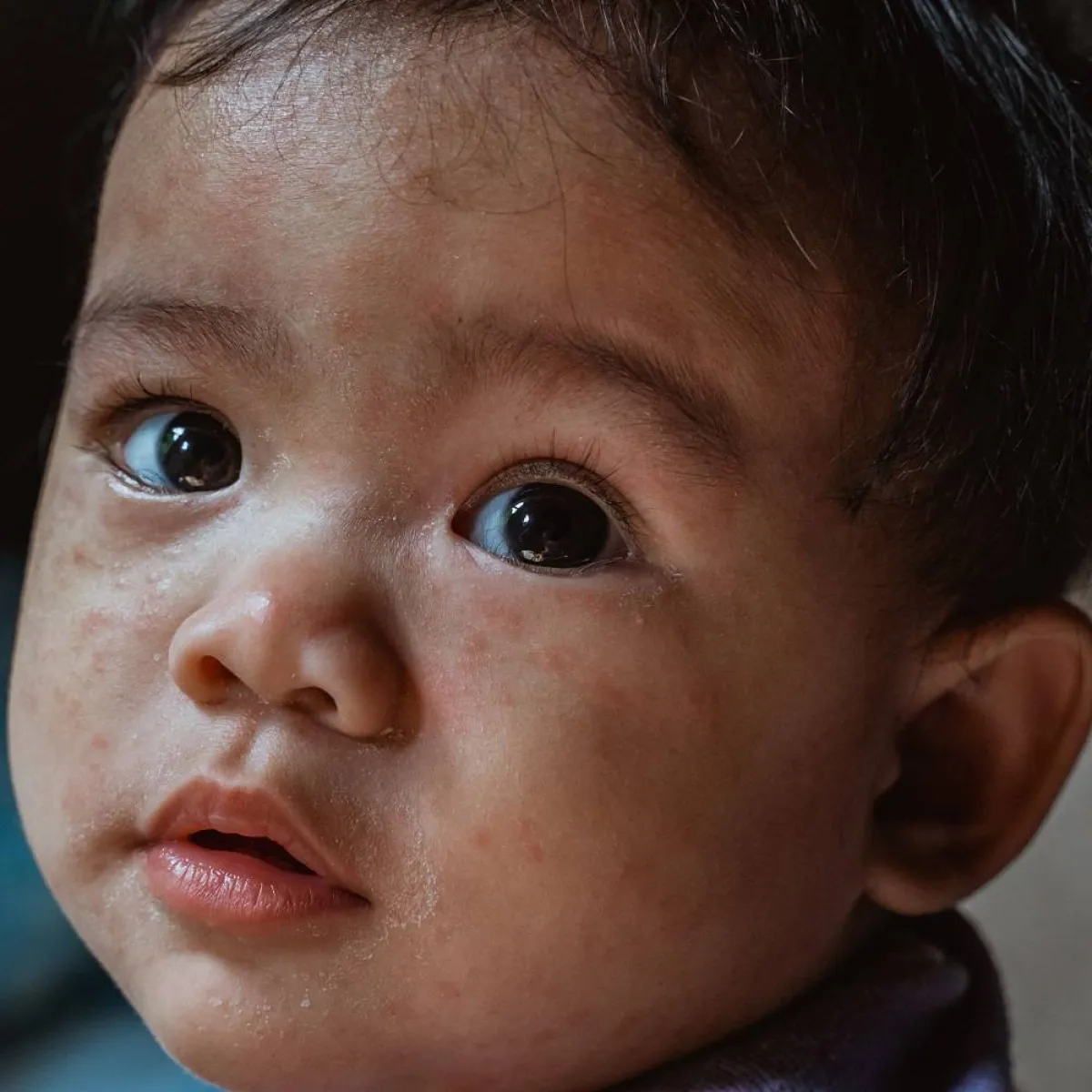 صورة لطفل يتعرض لإلتهابات جلدية