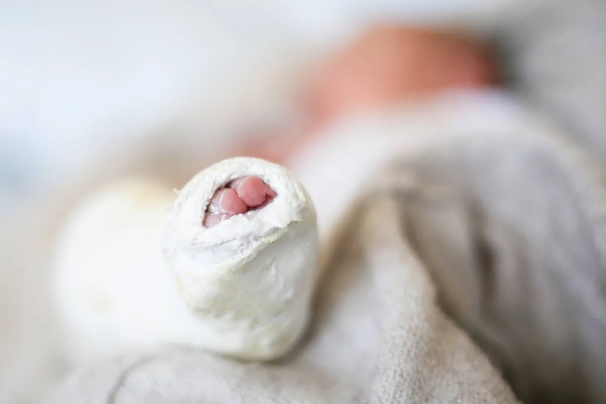 صورة لعلاج حنف القدم