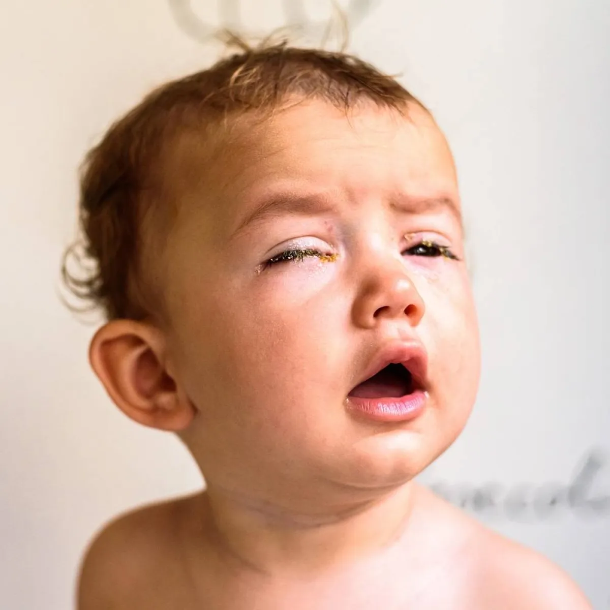 صورة لطفل يشكو من عينيه