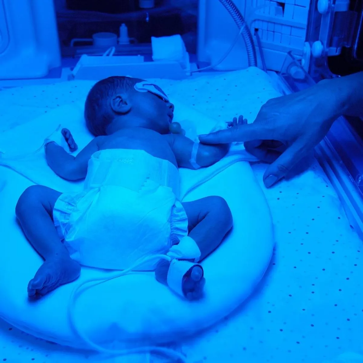 صورة لمولود جديد يعالج بالضوء