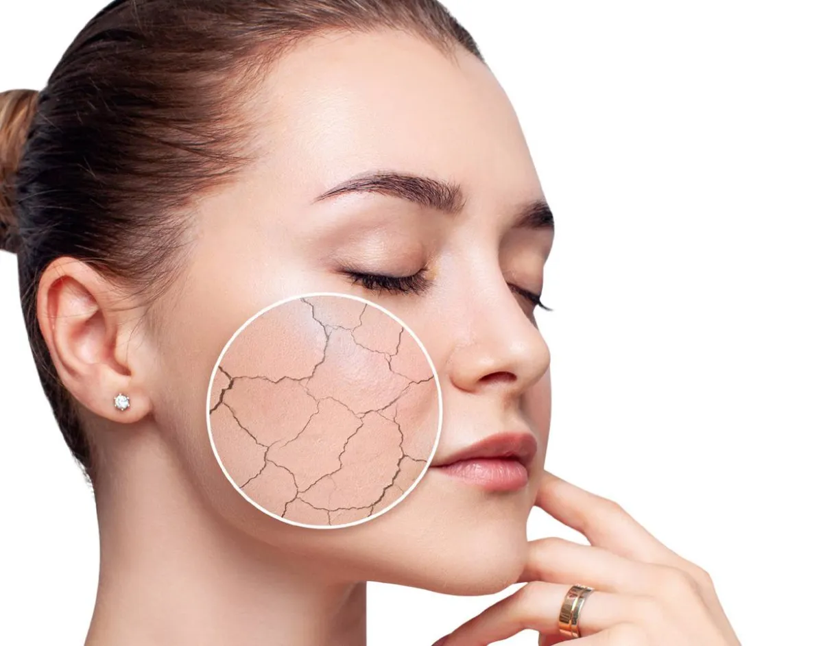 احمي بشرتك من التشققات الجلدية في الشتاء Cracked Skin